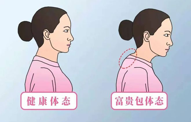 杏彩体育，“富贵包”是种病缓解症状有妙招丨健康智慧屋